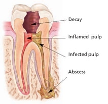 infected tooth