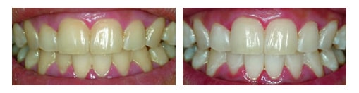zoom-before-after