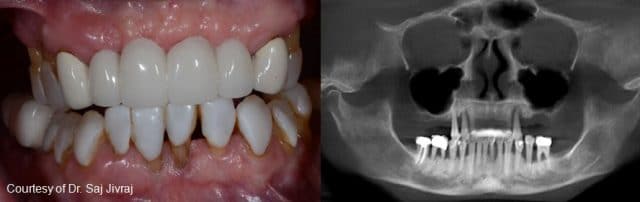All On Four Dental Treatment Plans