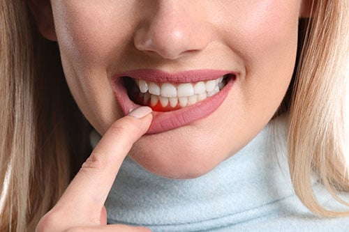 Woman with gingivitis