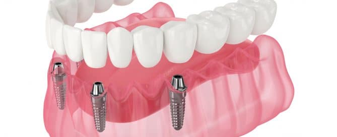 All On Four Procedure