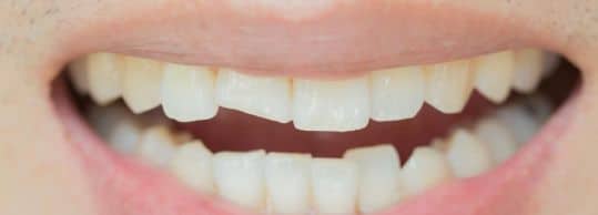 Common Reasons Teeth Crack or Break