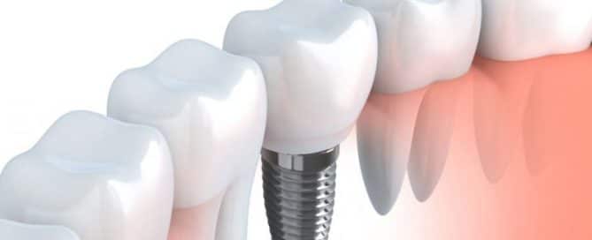 Dental Implants vs Other Tooth Replacement Options