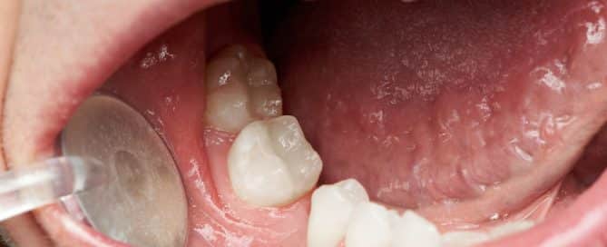 How Bone Loss Happens After Tooth Loss