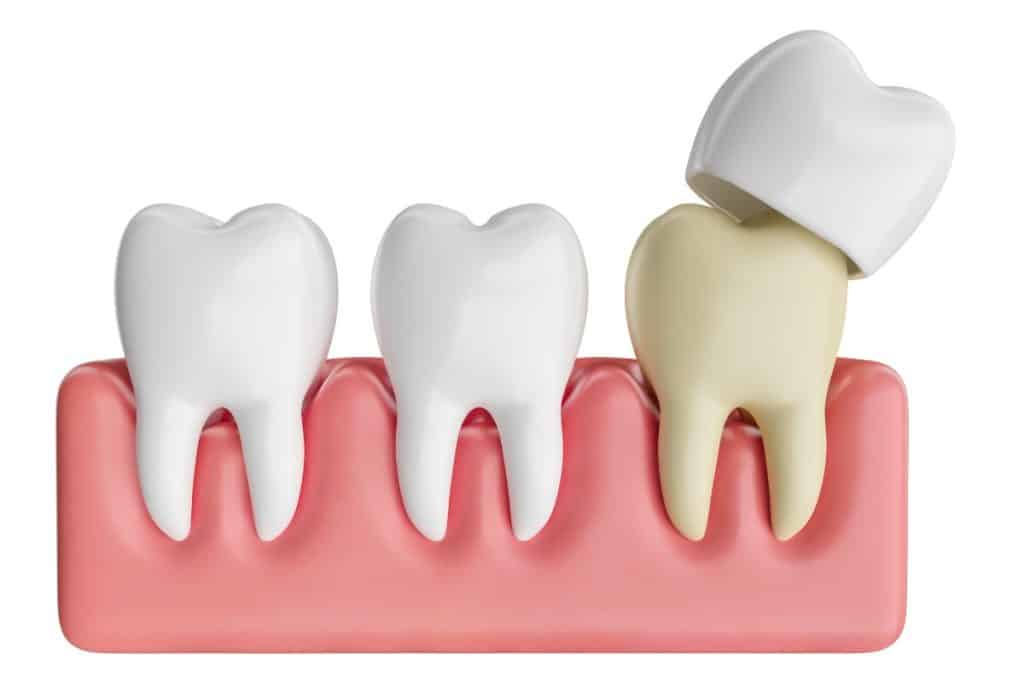 How Long Do Dental Crowns Last?