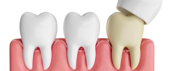 How Long Do Dental Crowns Last