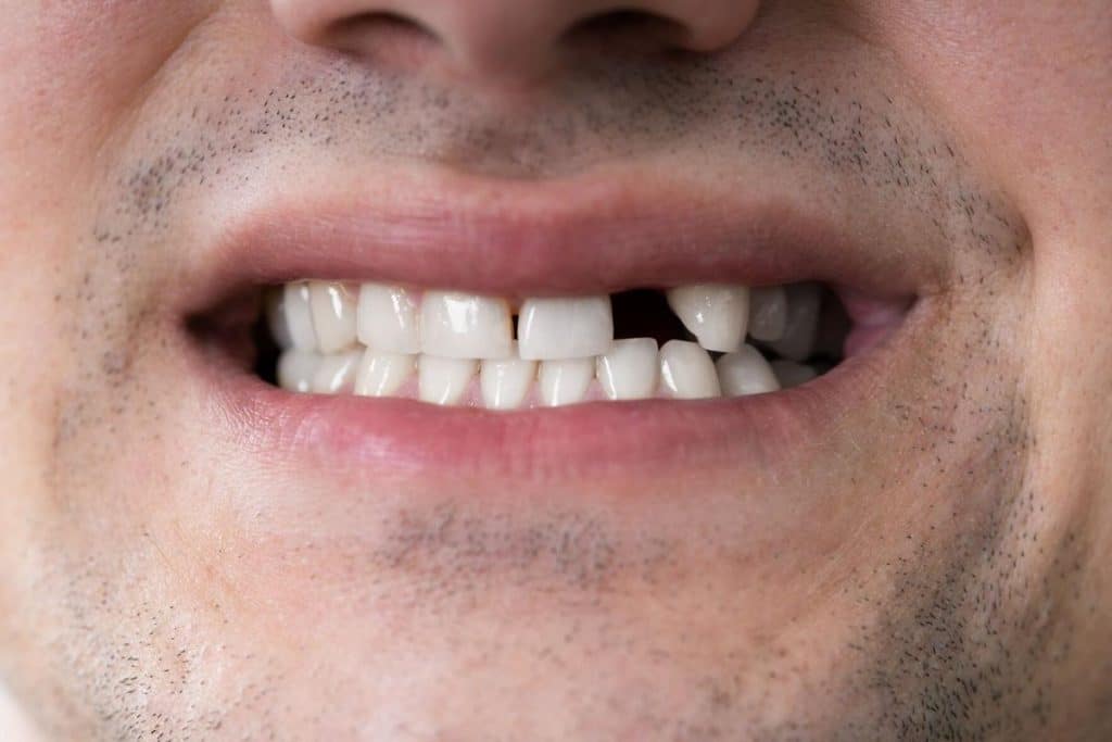 Why Missing Teeth Affect Oral Health?