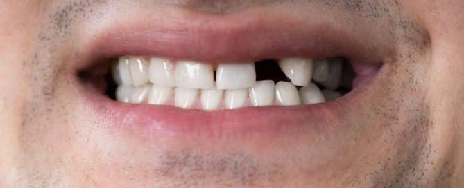 Why Missing Teeth Affect Oral Health
