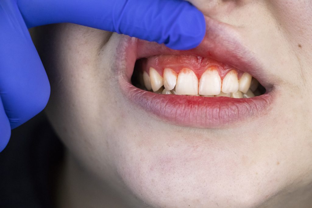 Early Signs of Gum Disease