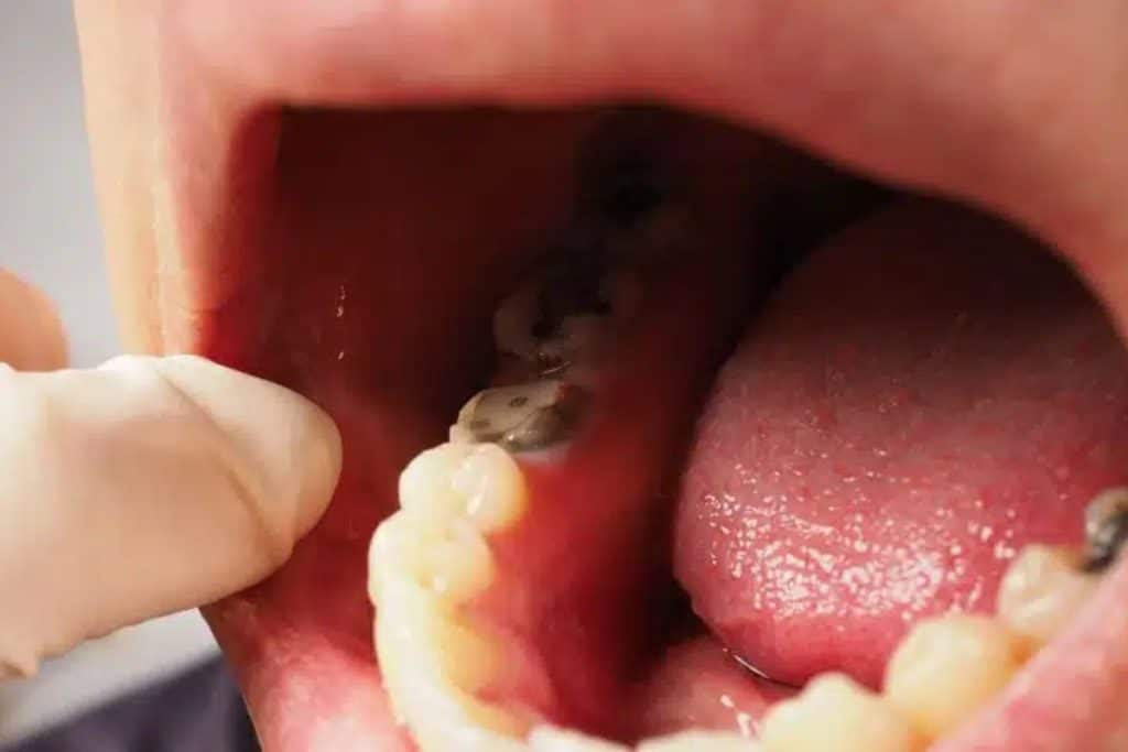Signs You May Need a Root Canal