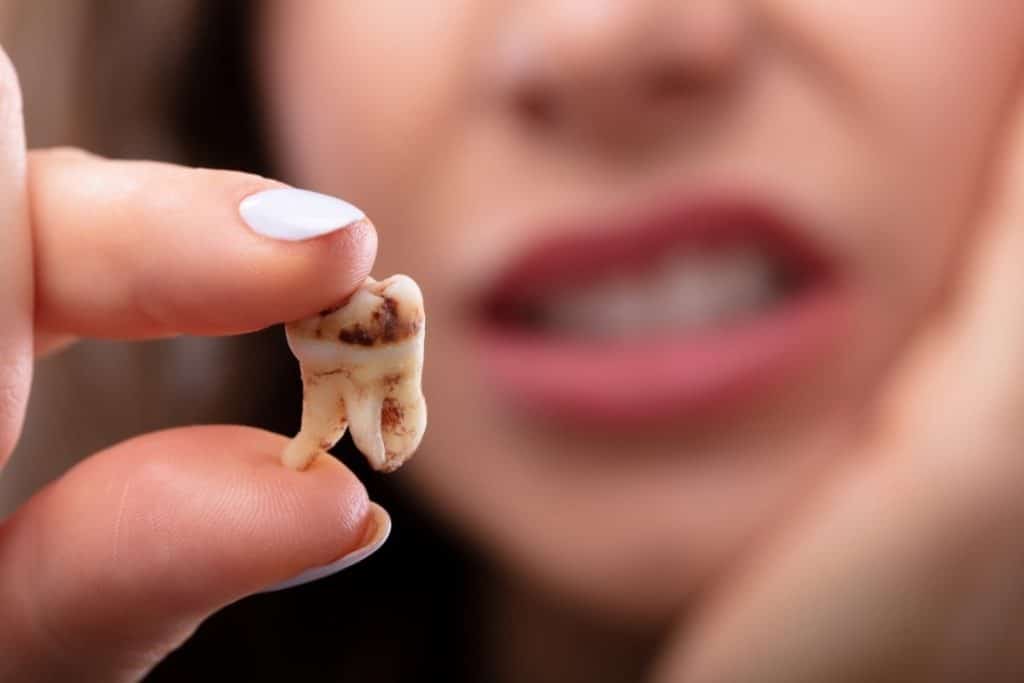 Wisdom Teeth Removal Recovery Timeline